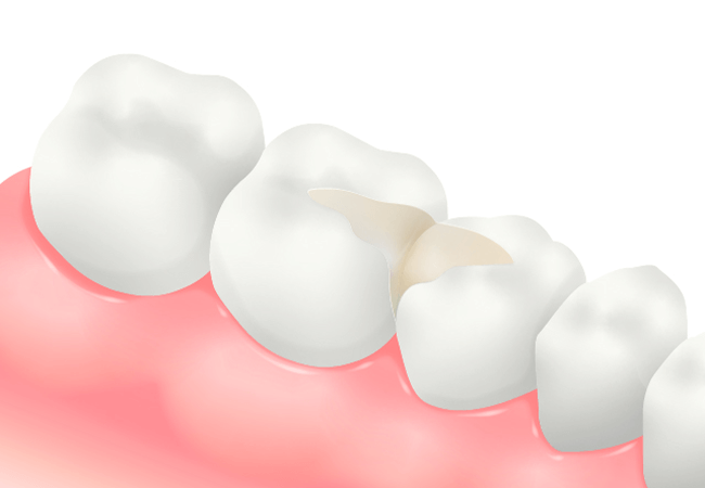 コンポジットレジンインレー