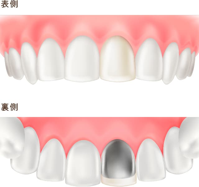 レジン前装金属冠
