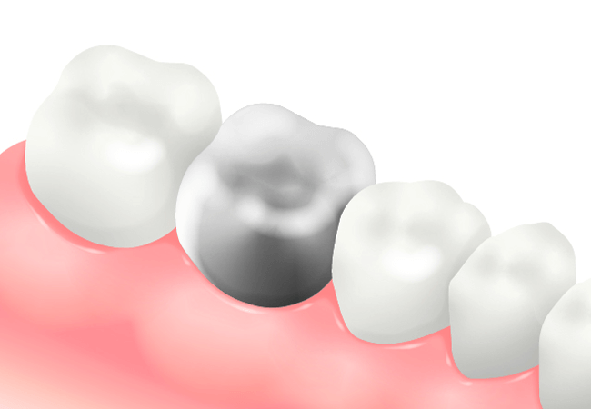 メタルクラウン（金属冠：銀歯）