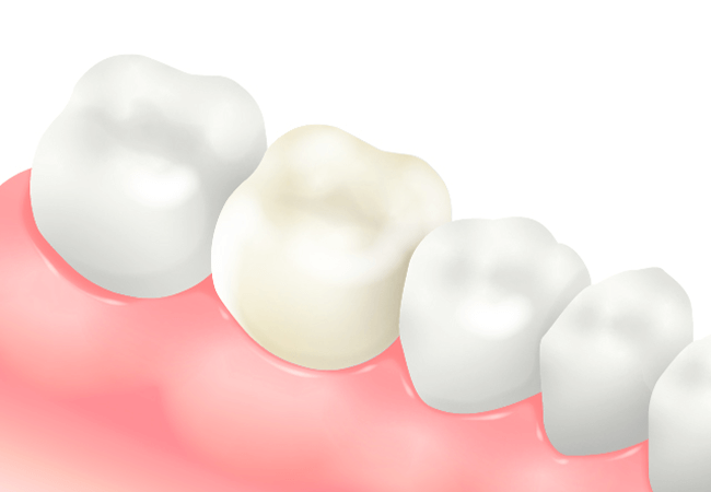 オールセラミッククラウン