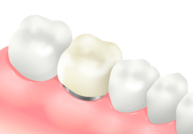 メタルボンドセラミッククラウン