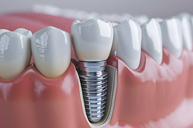 インプラント治療とは