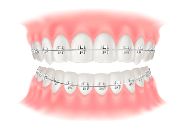 表側矯正（ワイヤー矯正）