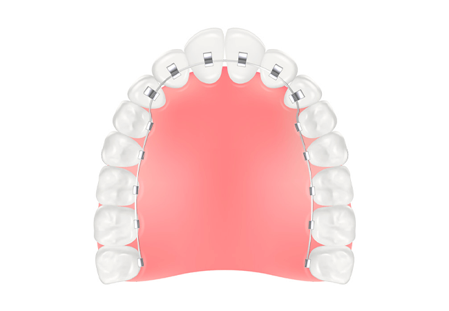 裏側矯正（リンガル矯正）