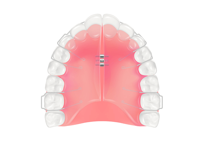 床矯正（しょうきょうせい）